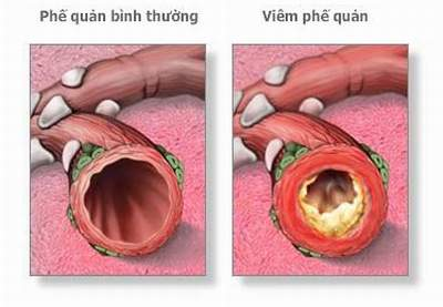 Tình trạng viêm phế quản làm phế quản bị thu hẹp bởi dịch nhầy, gây khó lưu thông khí cho bệnh nhân