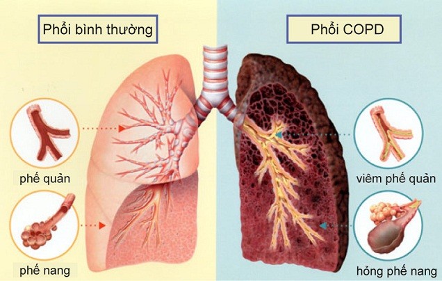 Bệnh phổi tắc nghẽn mãn tính COPD và những điều cần biết