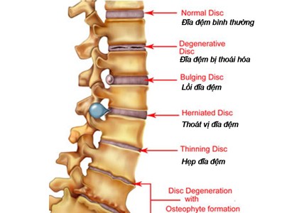 Tình trạng thoát vị đĩa đệm 