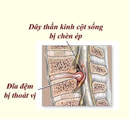 Bệnh lý thoát vị đĩa đệm