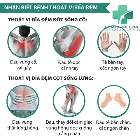 Triệu chứng nhận biết thoát vị đĩa đệm