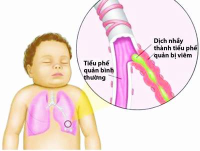 Mùa mưa, tỷ lệ trẻ em mắc viêm phế quản tăng mạnh